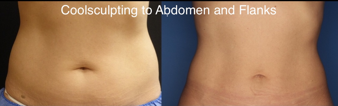 CoolSculpting Before & After Gallery - Patient 24560528 - Image 2