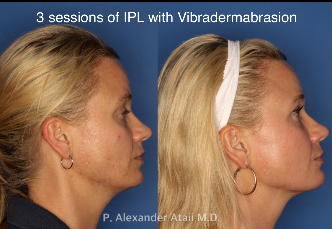 IPL Photorejuvenation Before & After Gallery - Patient 24560548 - Image 5