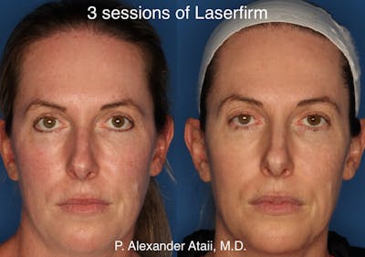LaserFirm Before & After Gallery - Patient 24560576 - Image 1