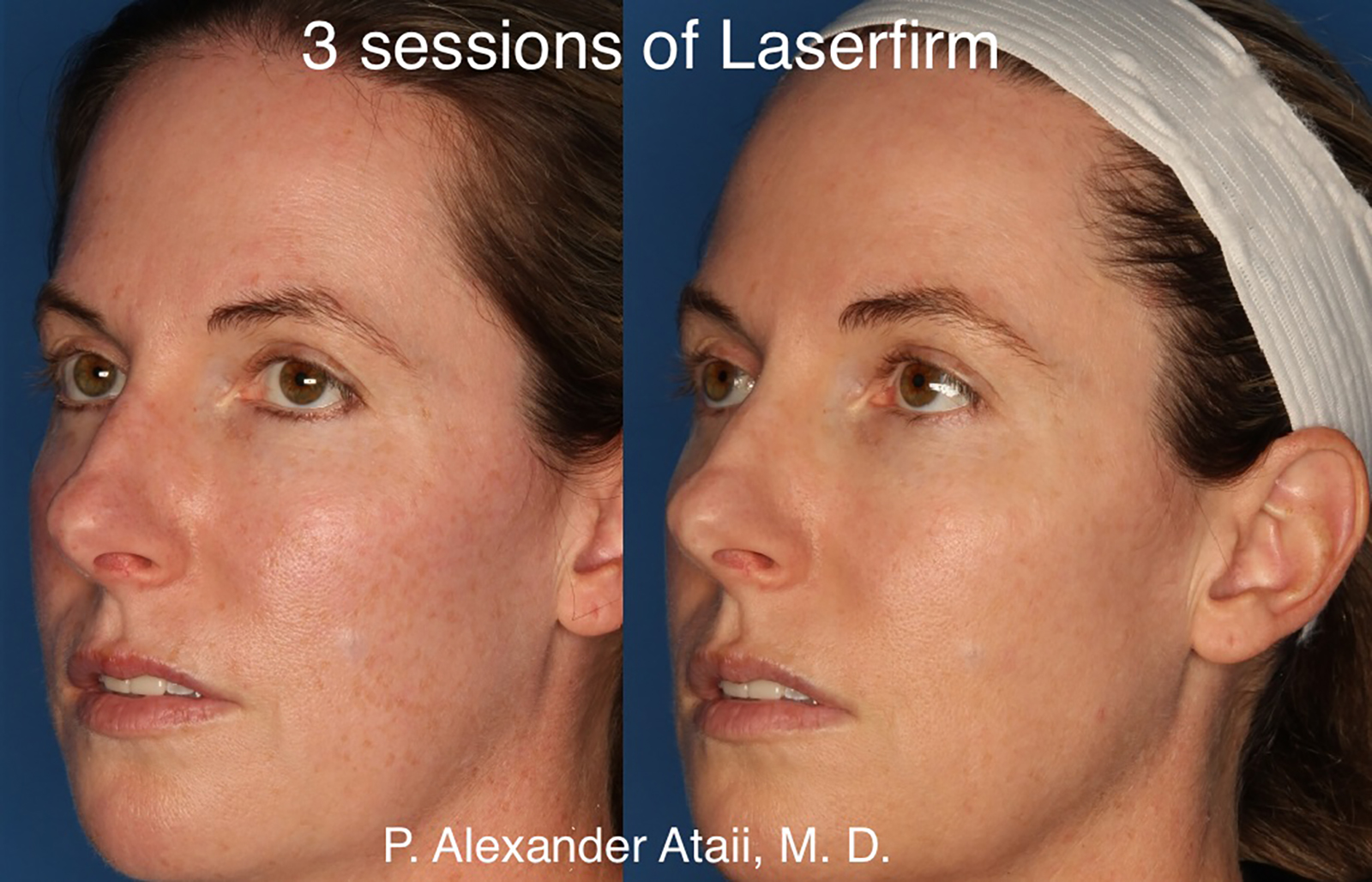 LaserFirm Before & After Gallery - Patient 24560576 - Image 2