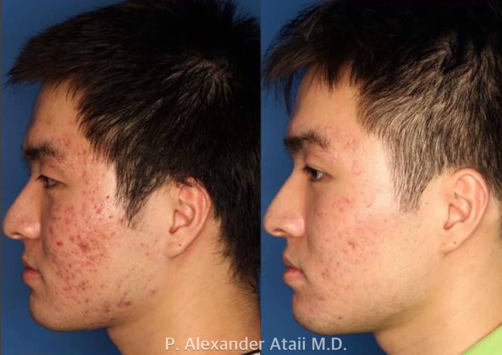 Photodynamic Therapy with Blu-U Before & After Gallery - Patient 24560629 - Image 2