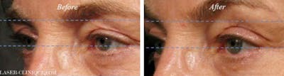 Ultherapy Before & After Gallery - Patient 24560664 - Image 1