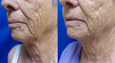 Ultherapy Before & After Gallery - Patient 24560671 - Image 2
