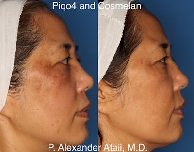 PiQo4™ Laser Before & After Gallery - Patient 24560672 - Image 2