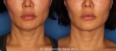 Ultherapy Before & After Gallery - Patient 24560678 - Image 1
