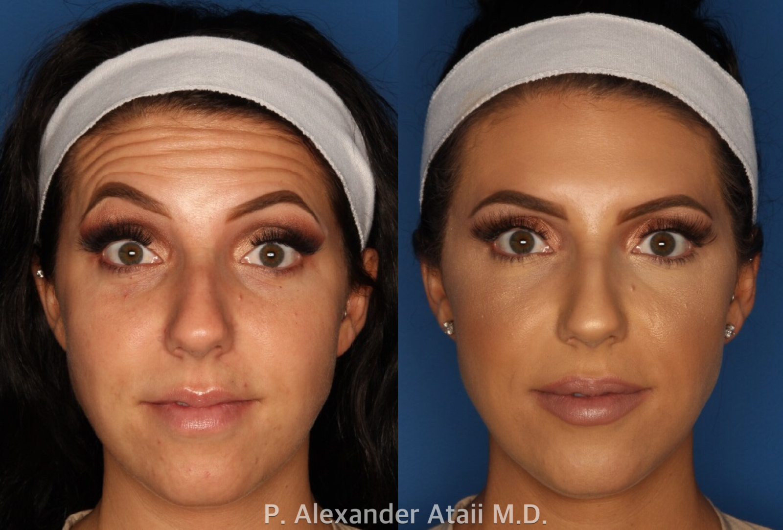 Botox/ Dysport/ Xeomin Before & After Gallery - Patient 24560738 - Image 2