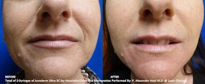 Dermal Fillers Before & After Gallery - Patient 188462 - Image 1