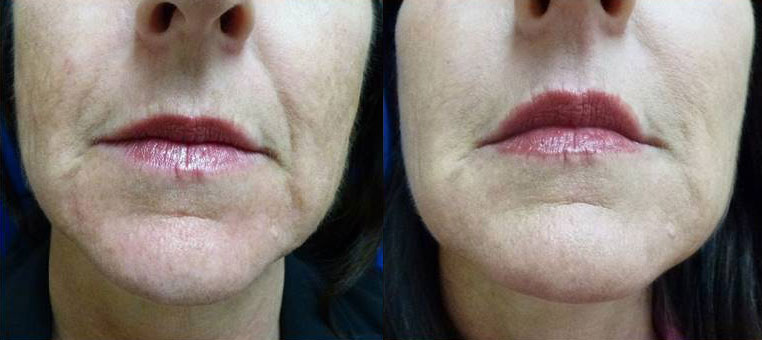 Dermal Fillers Before & After Gallery - Patient 168327 - Image 1