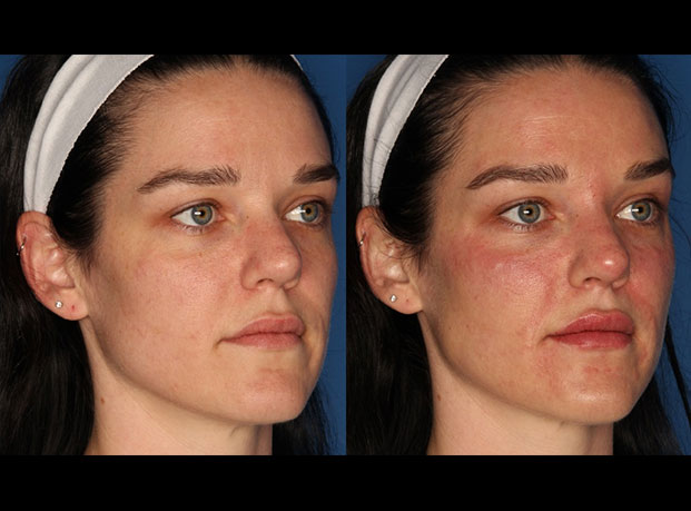 Dermal Fillers Before & After Gallery - Patient 327074 - Image 3