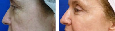 Dermal Fillers Before & After Gallery - Patient 600407 - Image 1