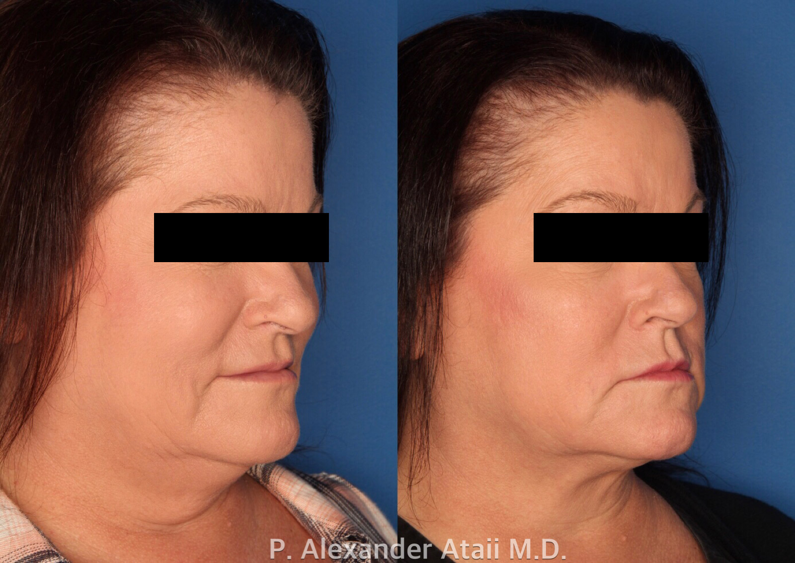 Kybella Before & After Gallery - Patient 24560802 - Image 3