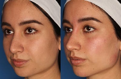 Dermal Fillers Before & After Gallery - Patient 339197 - Image 1
