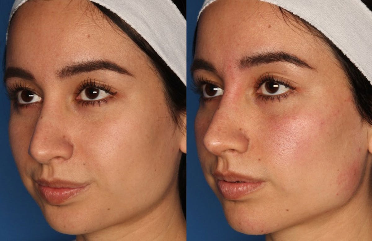 Dermal Fillers Before & After Gallery - Patient 339197 - Image 1