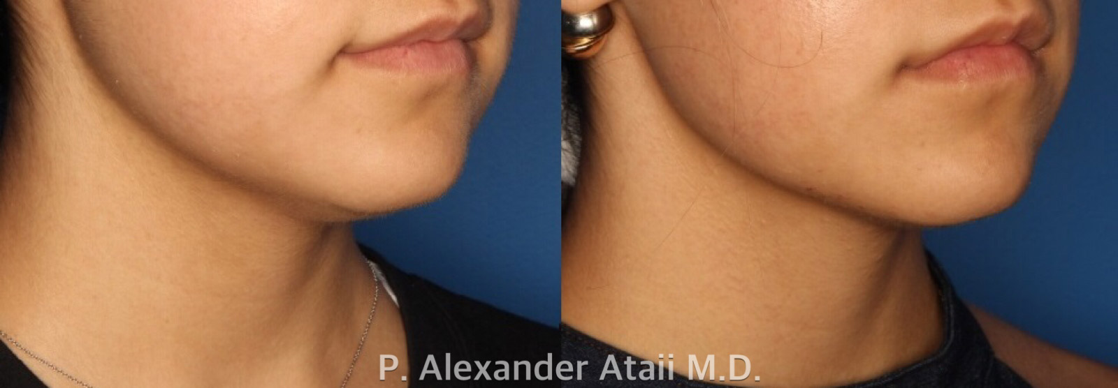 Kybella Before & After Gallery - Patient 24560851 - Image 2
