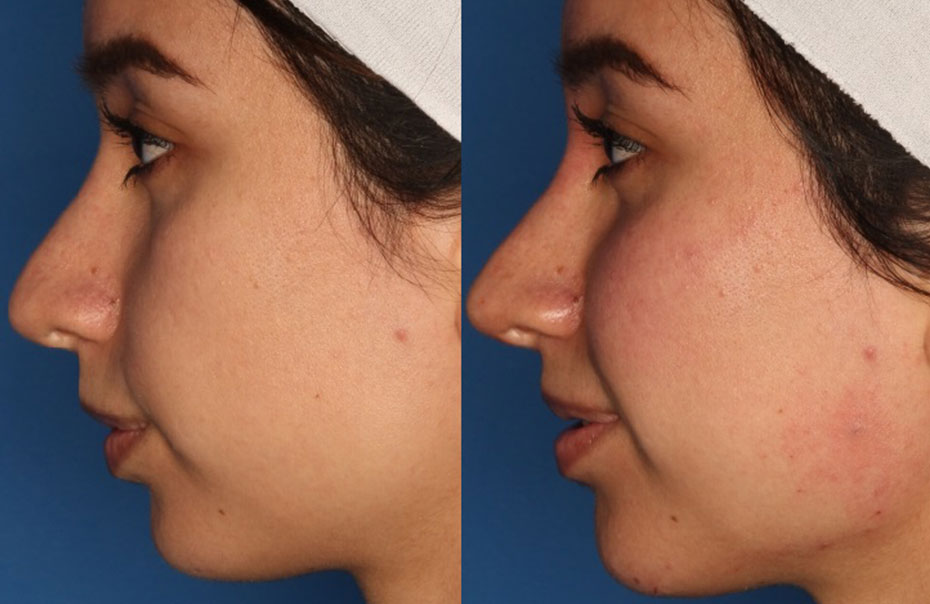 Non-Surgical Rhinoplasty Before & After Gallery - Patient 24560853 - Image 3