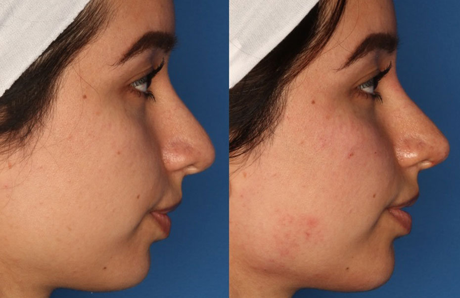 Non-Surgical Rhinoplasty Before & After Gallery - Patient 24560853 - Image 4