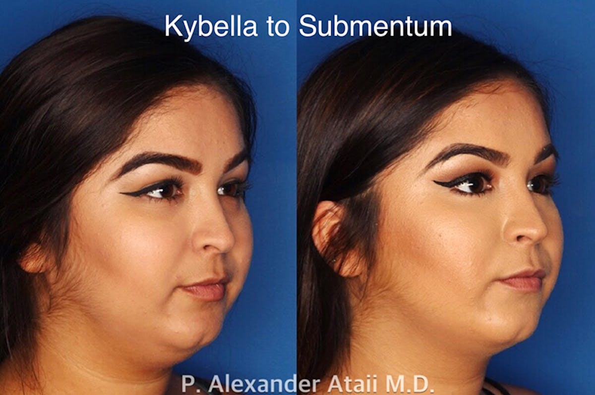 Kybella Before & After Gallery - Patient 24560865 - Image 1