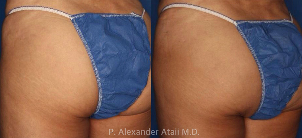Sculptra Aesthetic Before & After Gallery - Patient 24560897 - Image 1