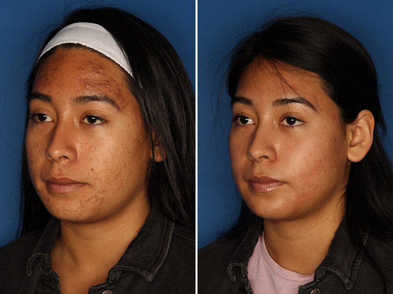 Acne Treatment Before & After Gallery - Patient 24560911 - Image 3