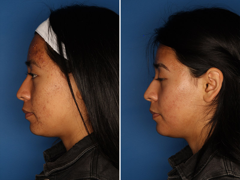 Acne Treatment Before & After Gallery - Patient 24560911 - Image 5