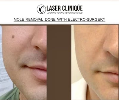 Mole Removal Before & After Gallery - Patient 24560971 - Image 1