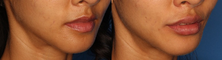 Lip Augmentation Before & After Gallery - Patient 24560972 - Image 3