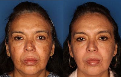Medical Grade Chemical Peels Before & After Gallery - Patient 24560973 - Image 1