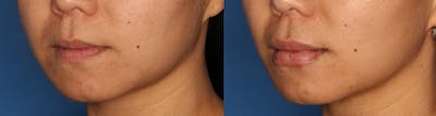 Lip Augmentation Before & After Gallery - Patient 24560974 - Image 2