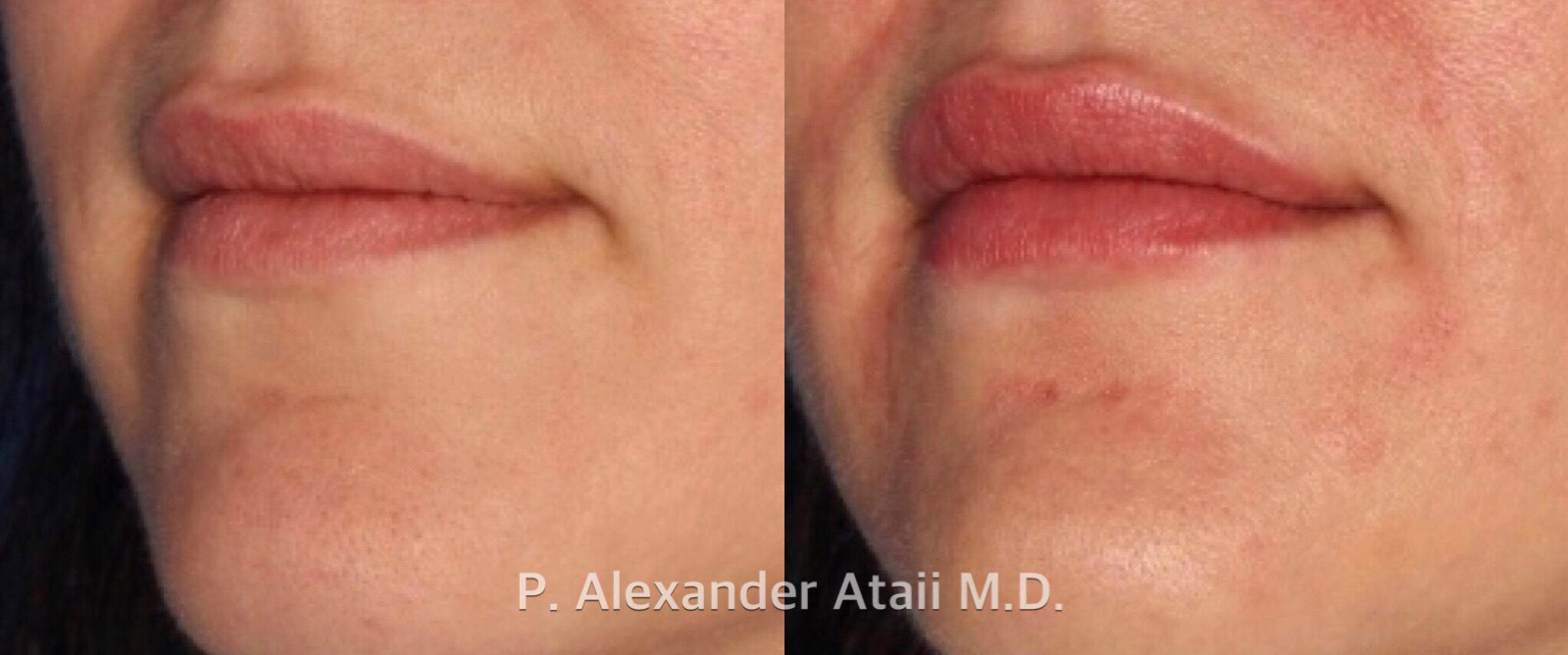 Lip Augmentation Before & After Gallery - Patient 24560981 - Image 3