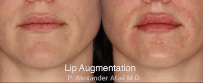Lip Augmentation Before & After Gallery - Patient 24560984 - Image 1