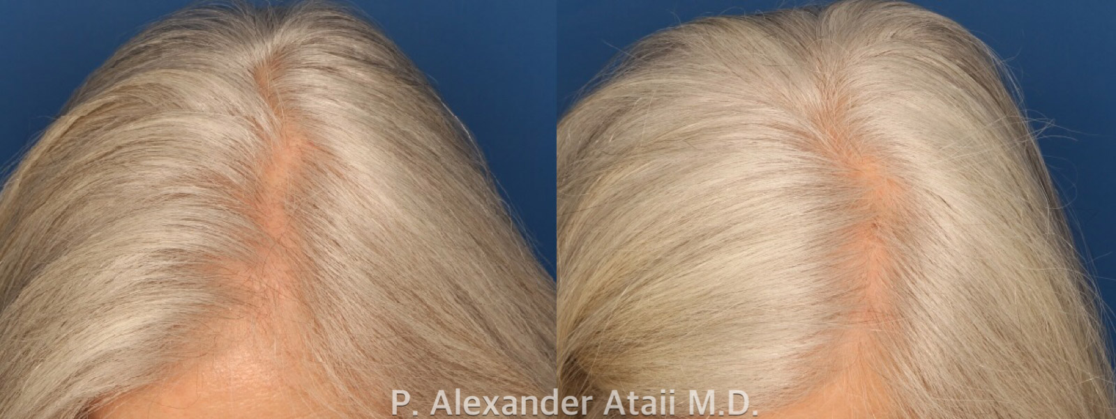 PRP Hair Loss Before & After Gallery - Patient 24560985 - Image 3