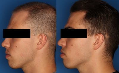 PRP Hair Loss Before & After Gallery - Patient 24560991 - Image 2
