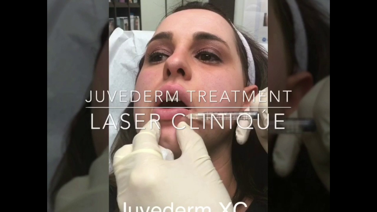Video of Juvederm injection by Dr. Ataii.