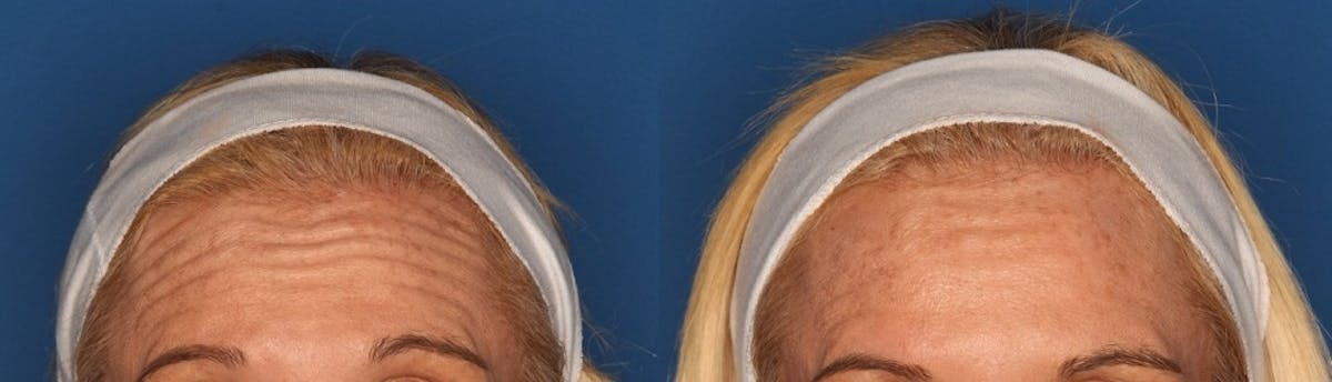 Botox/ Dysport/ Xeomin Before & After Gallery - Patient 36601572 - Image 1