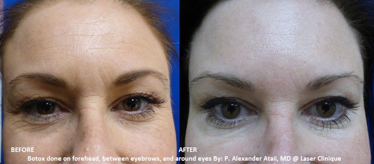 Botox/ Dysport/ Xeomin Before & After Gallery - Patient 36601574 - Image 1