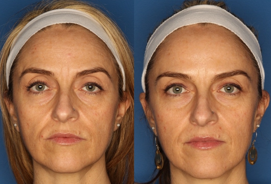 Botox/ Dysport/ Xeomin Before & After Gallery - Patient 24560702 - Image 3