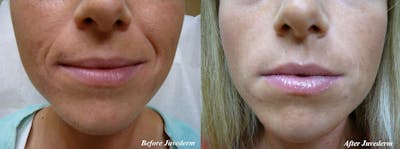 Dermal Fillers Before & After Gallery - Patient 211416 - Image 1