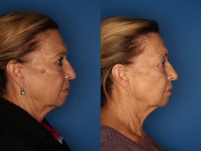 LaserFirm Before & After Gallery - Patient 41510379 - Image 2