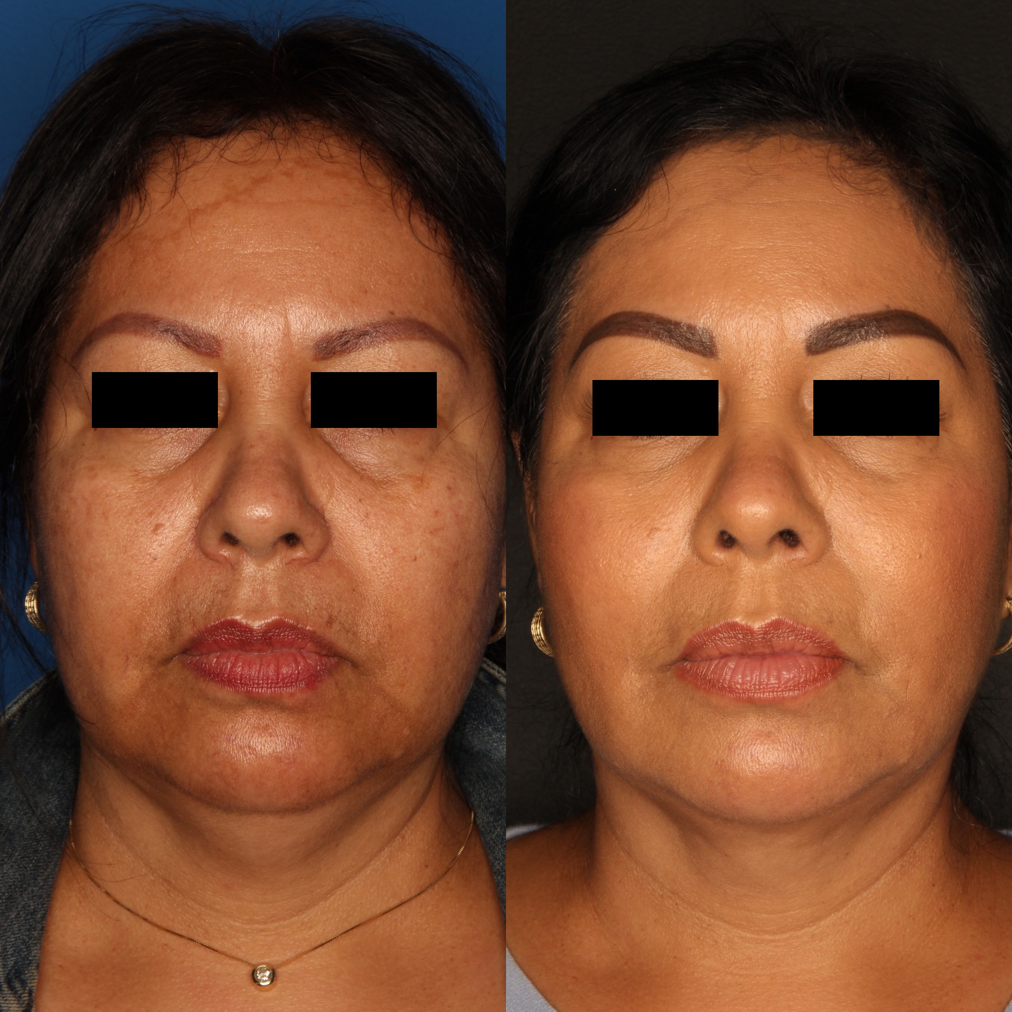 Liquid Facelift Before & After Gallery - Patient 59108135 - Image 2