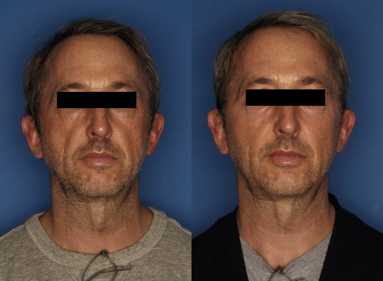 Sculptra Aesthetic Before & After Gallery - Patient 50726092 - Image 1