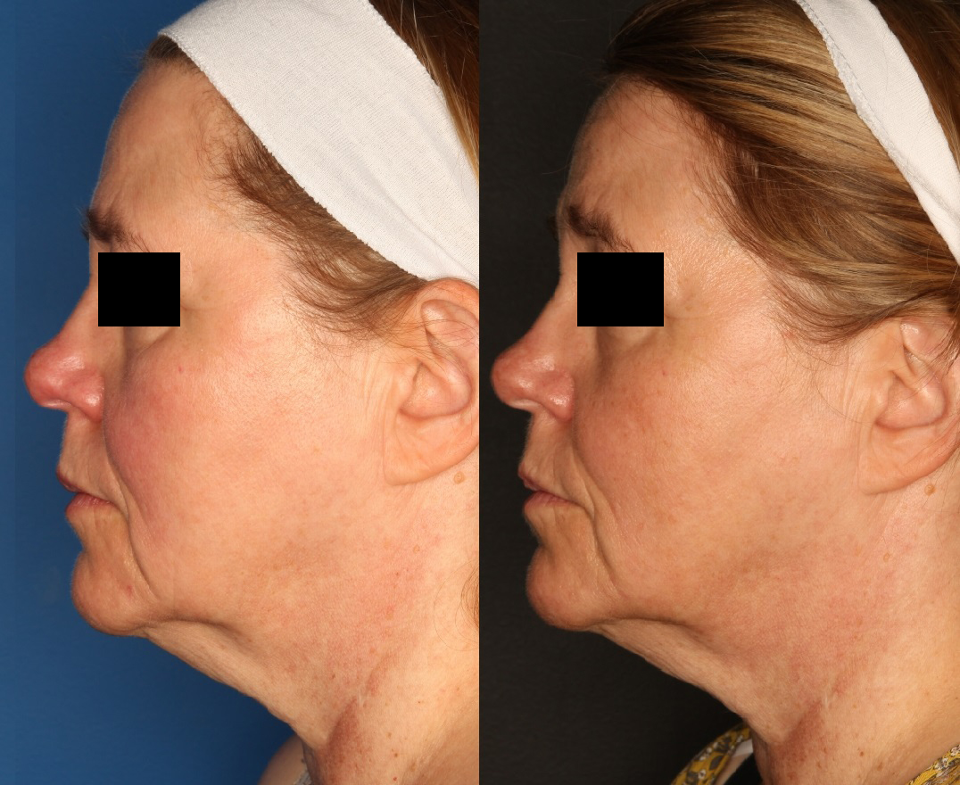 Excel V. Before & After Gallery - Patient 57949726 - Image 2