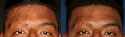 Microneedling Before & After Gallery - Patient 121121299 - Image 1