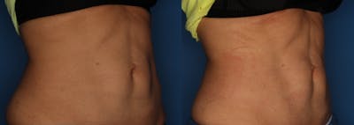 TruFlex Before & After Gallery - Patient 140401010 - Image 1