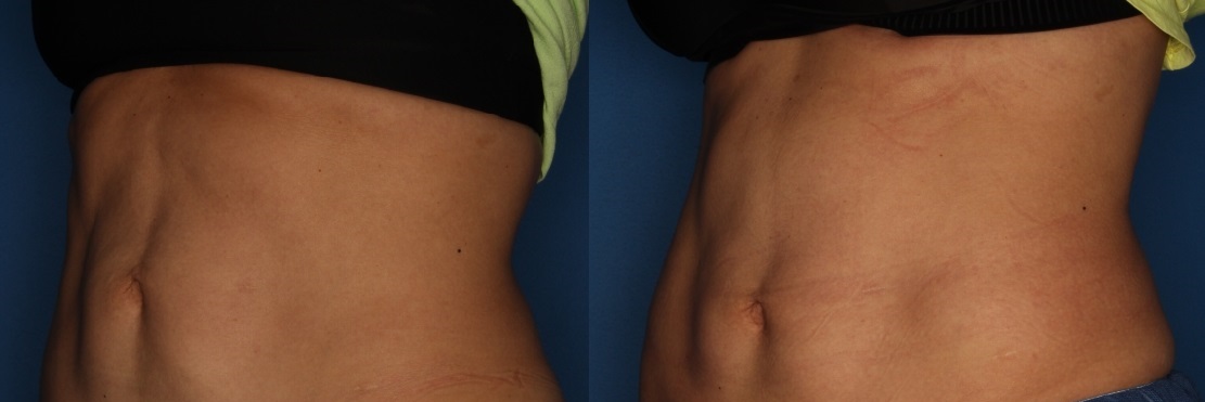TruFlex Before & After Gallery - Patient 140401010 - Image 2