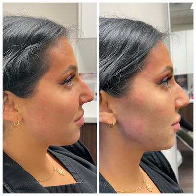 Jawline Augmentation Before & After Gallery - Patient 146804124 - Image 1