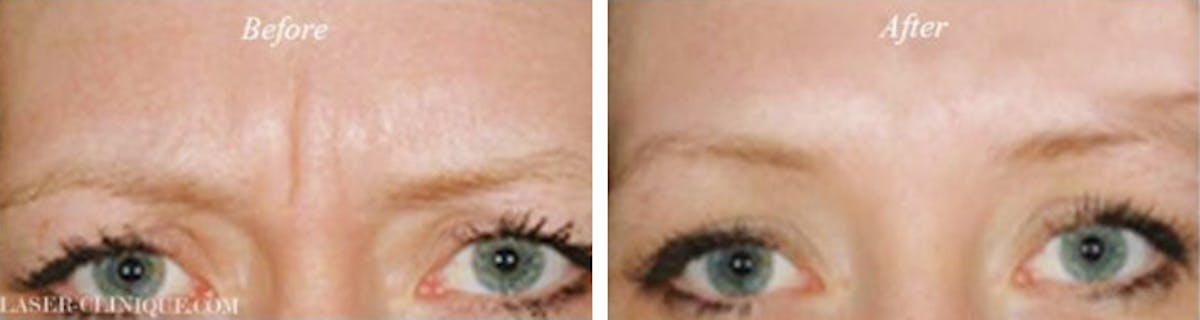 Botox/ Dysport/ Xeomin Before & After Gallery - Patient 149654 - Image 1