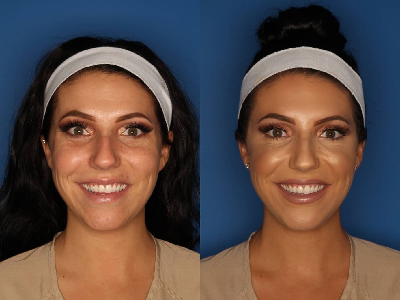 Botox/ Dysport/ Xeomin Before & After Gallery - Patient 158211 - Image 3