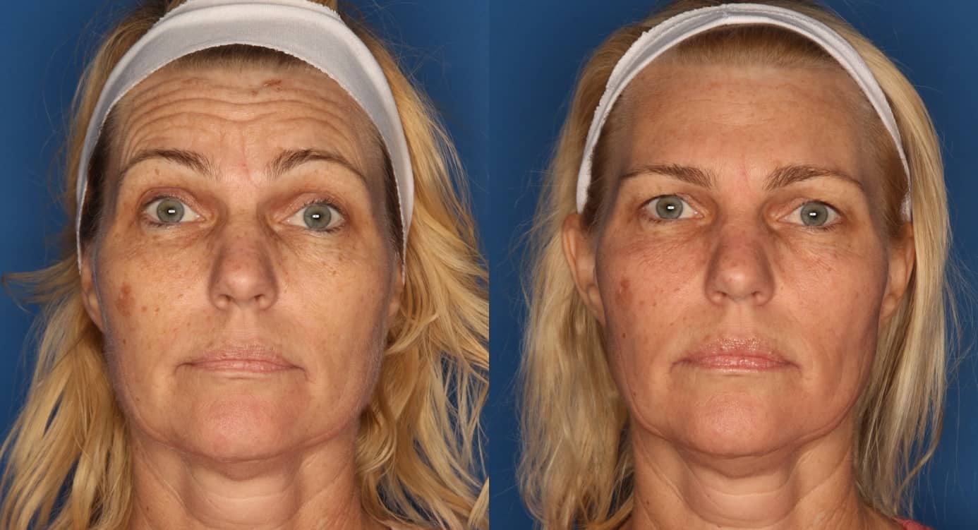 Botox/ Dysport/ Xeomin Before & After Gallery - Patient 321646 - Image 2