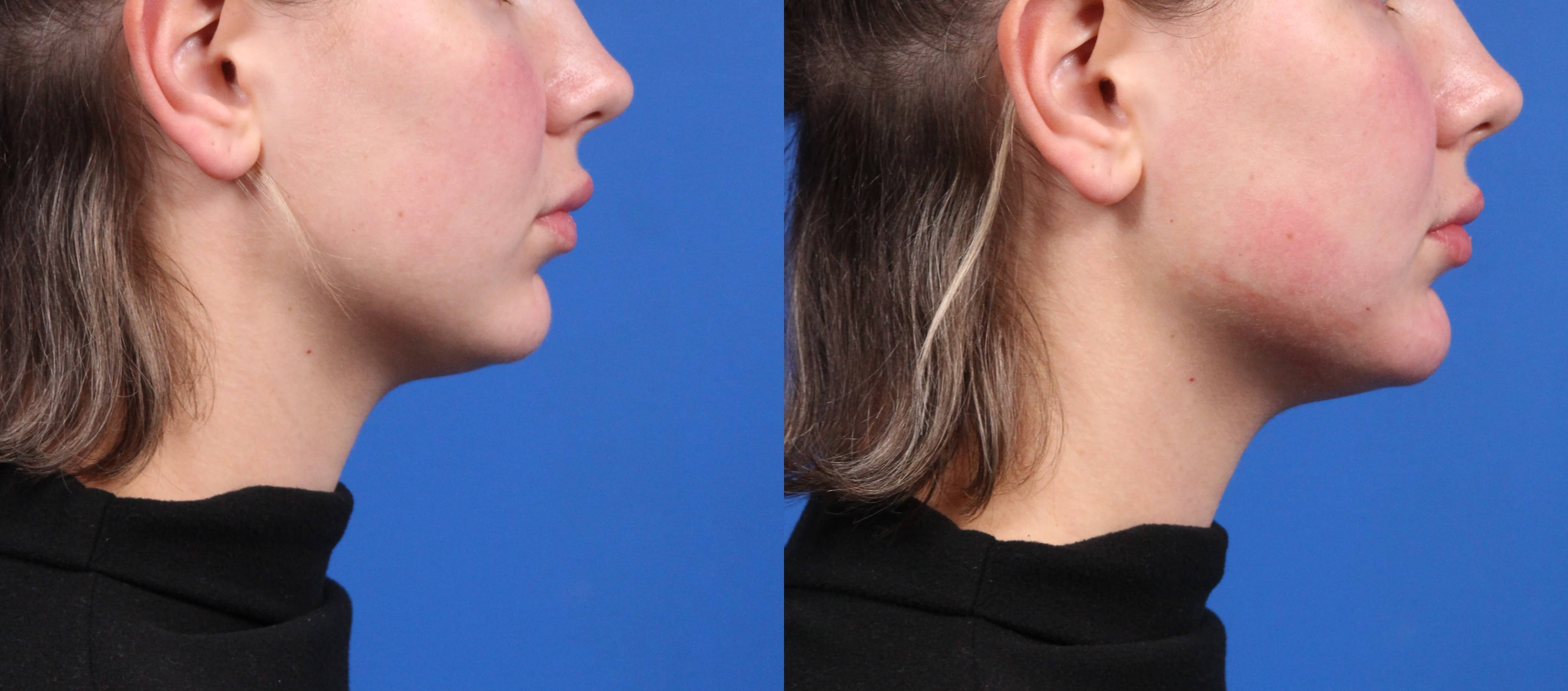Dermal Fillers Before & After Gallery - Patient 387290 - Image 3