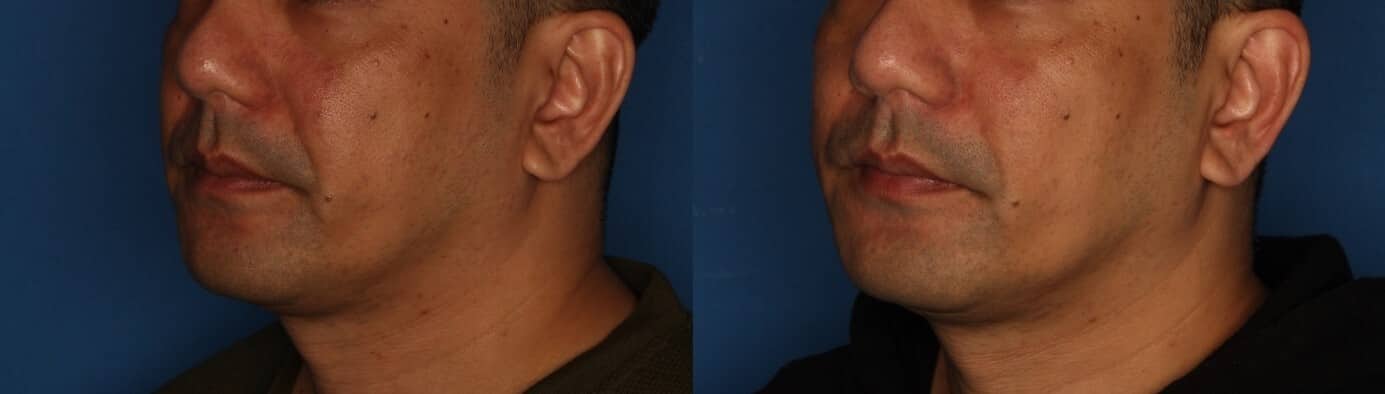Dermal Fillers Before & After Gallery - Patient 739477 - Image 2